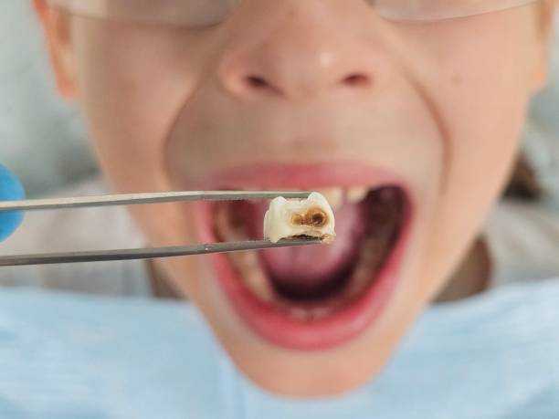 Best Tooth Infection Emergency Dentist  in Running Springs, CA